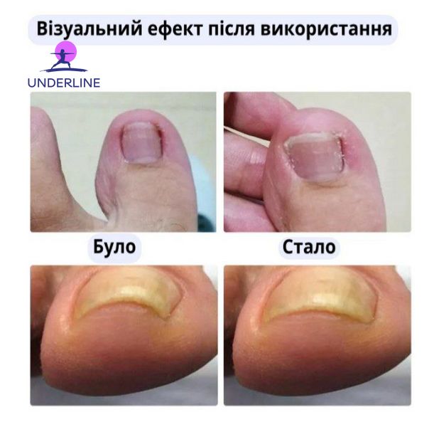 Набор пластырей Elastic Toenail Correction Sticker для коррекции и устранения вросших ногтей (50 шт.) PT17 фото